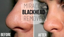 Remove Blackheads From Your Face With Pilaten Peel Off Face Mask