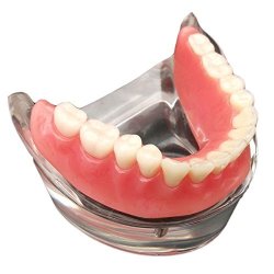 Dental Overdenture Inferior With 2 Implants Demo Model Study Model