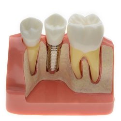 AZDENT Dental Model Implant Analysis Crown Bridge Demonstration Teeth Model For Education
