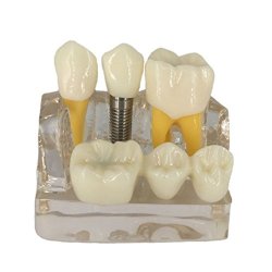 YOUYA DENTAL Youya 4 Times Dental Model Study Implant Analysis Crown Bridge Demonstration Teeth Model For Education Transparent